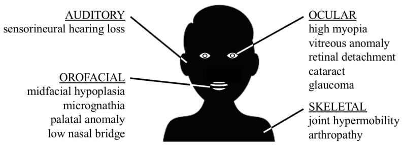 Schematic diagram of the four body systems affected in Stickler syndrome - ocular, orofacial, auditory and skeletal