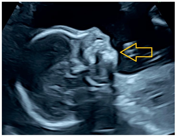 Prenatal ultrasound of the fetal facial profile showing marked micrognathia