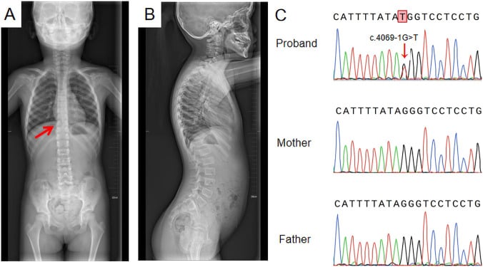 Full-length AP spine radiograph demonstrating platyspondyly and scoliosis in Stickler syndrome