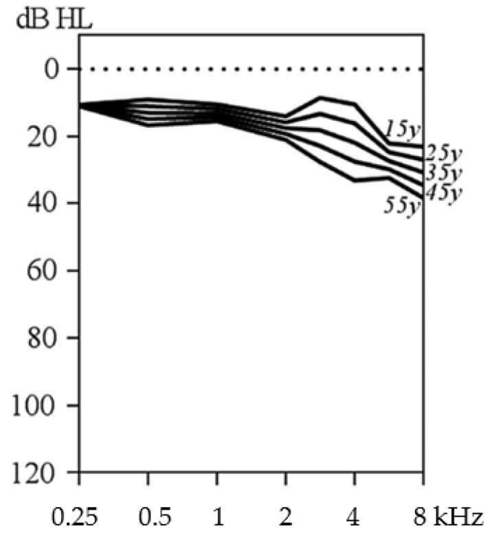 Age-related typical audiograms for sensorineural hearing loss in Stickler syndrome