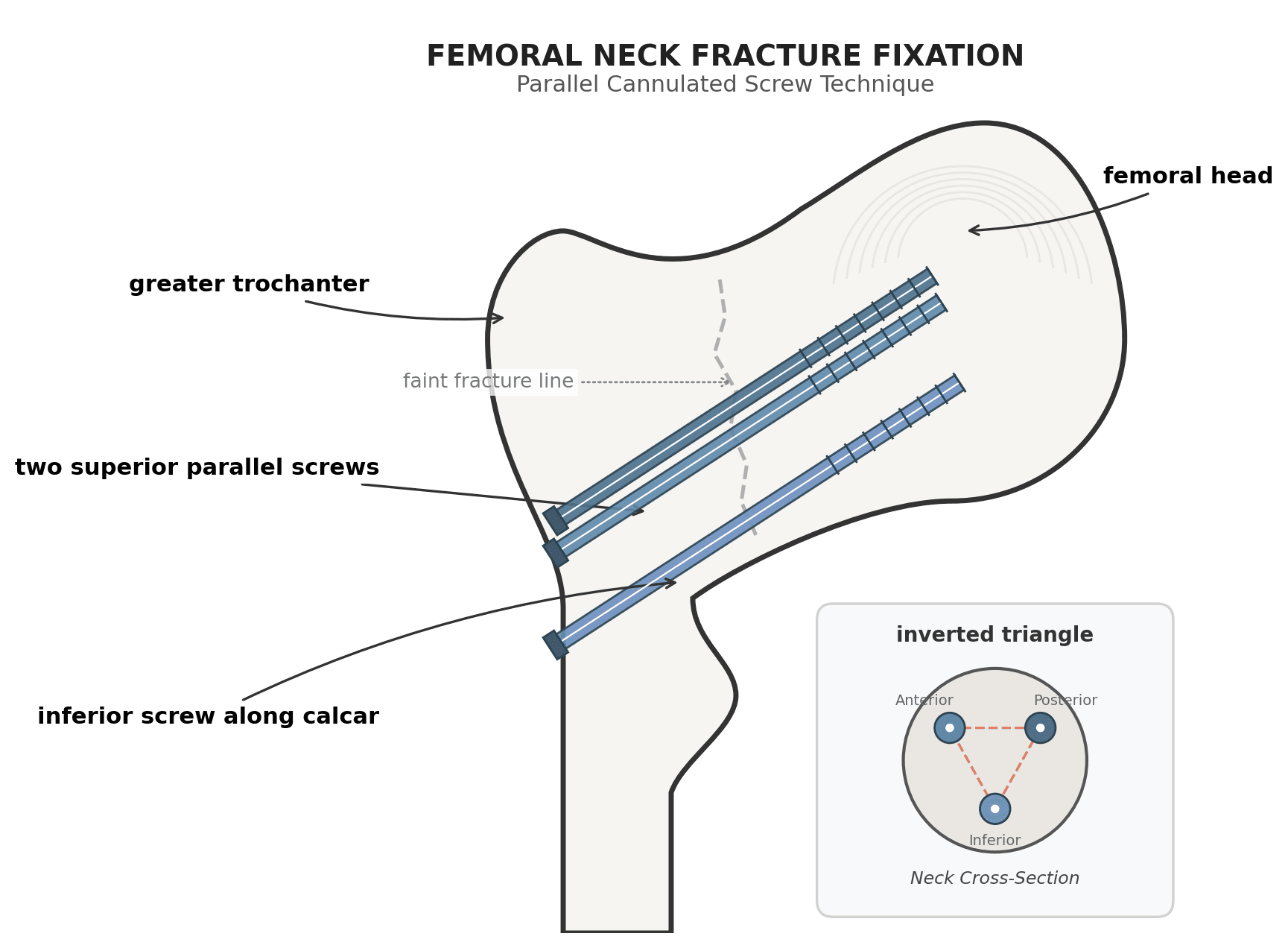 Diagram of femoral neck fixation with three cannulated screws in an inverted triangle configuration