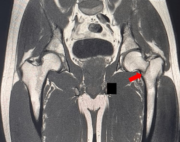 Coronal MRI showing a left femoral neck stress fracture in a high-performance athlete