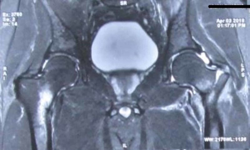 Pelvic MRI showing a displaced basicervical stress fracture on the left and an incomplete femoral neck stress fracture on the right