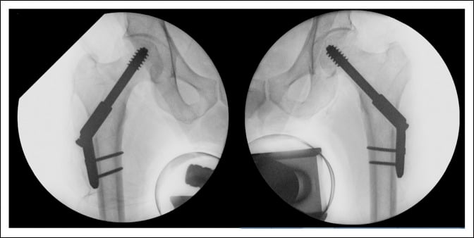 Bilateral intraoperative fluoroscopic images showing two-hole dynamic hip screw fixation of femoral neck insufficiency fractures