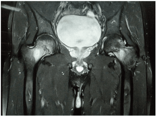 Coronal MRI of both hips showing bilateral femoral neck stress fractures