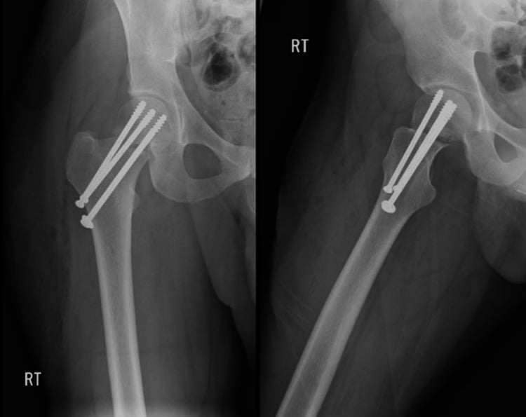 AP and lateral hip radiographs after closed reduction and three-cannulated-screw fixation of a displaced femoral neck stress fracture