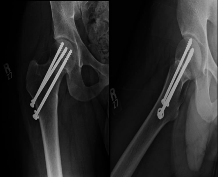 AP and lateral hip radiographs showing complete union after cannulated-screw fixation of a displaced femoral neck stress fracture