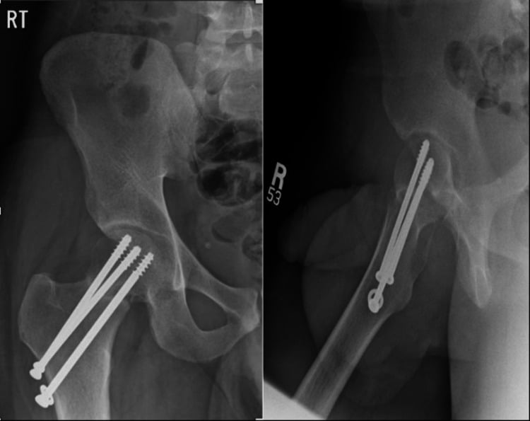 Follow-up AP and lateral hip radiographs showing absent union after cannulated-screw fixation of a displaced femoral neck stress fracture