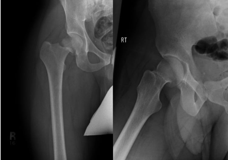 Classification example: AP and lateral hip radiographs showing a completely displaced femoral neck stress fracture in a young soldier