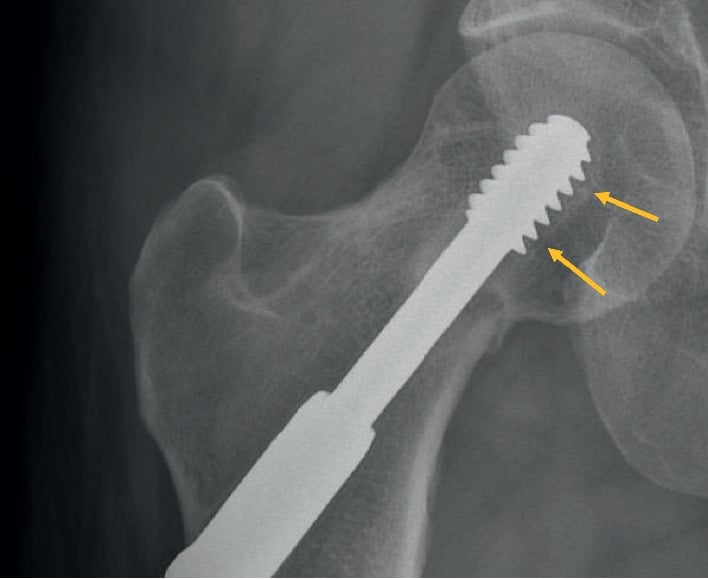 Hip radiograph showing lucency around a dynamic hip screw and a persistent compression-side femoral neck fracture line