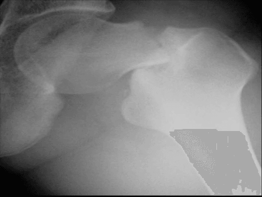 AP radiograph of the hip in a young runner with a femoral neck stress fracture