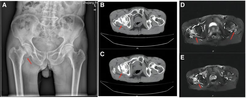 Pelvic radiograph and multiplanar CT showing a femoral neck stress fracture with cortical discontinuity