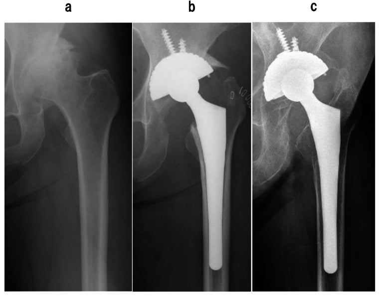 Serial hip radiographs before arthroplasty, immediately after implantation and at long-term follow-up showing proximal stress shielding