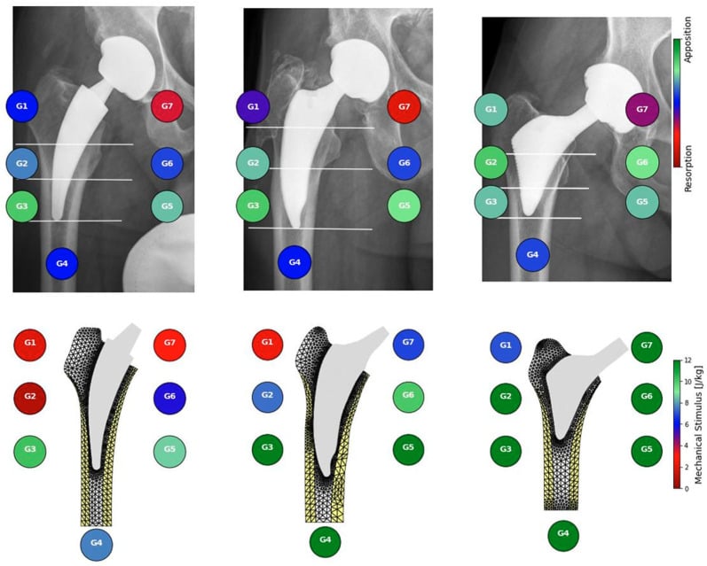 Radiographs and finite-element maps comparing proximal femoral remodelling and mechanical stimulus around three short hip stems