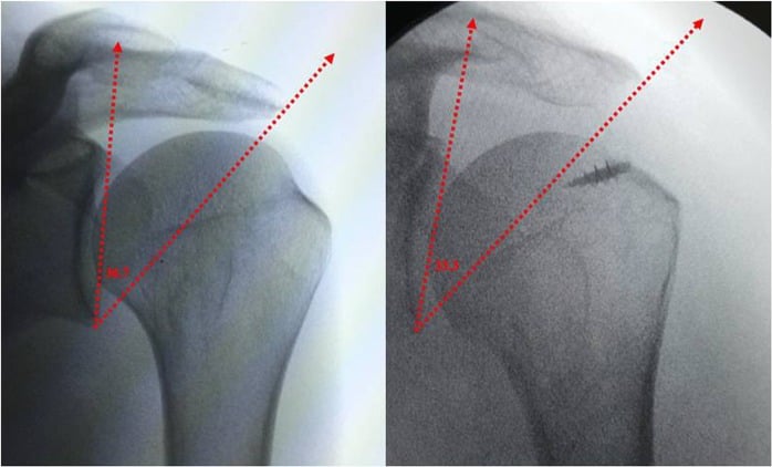 True anteroposterior fluoroscopic views showing reduction in critical shoulder angle after lateral acromioplasty.