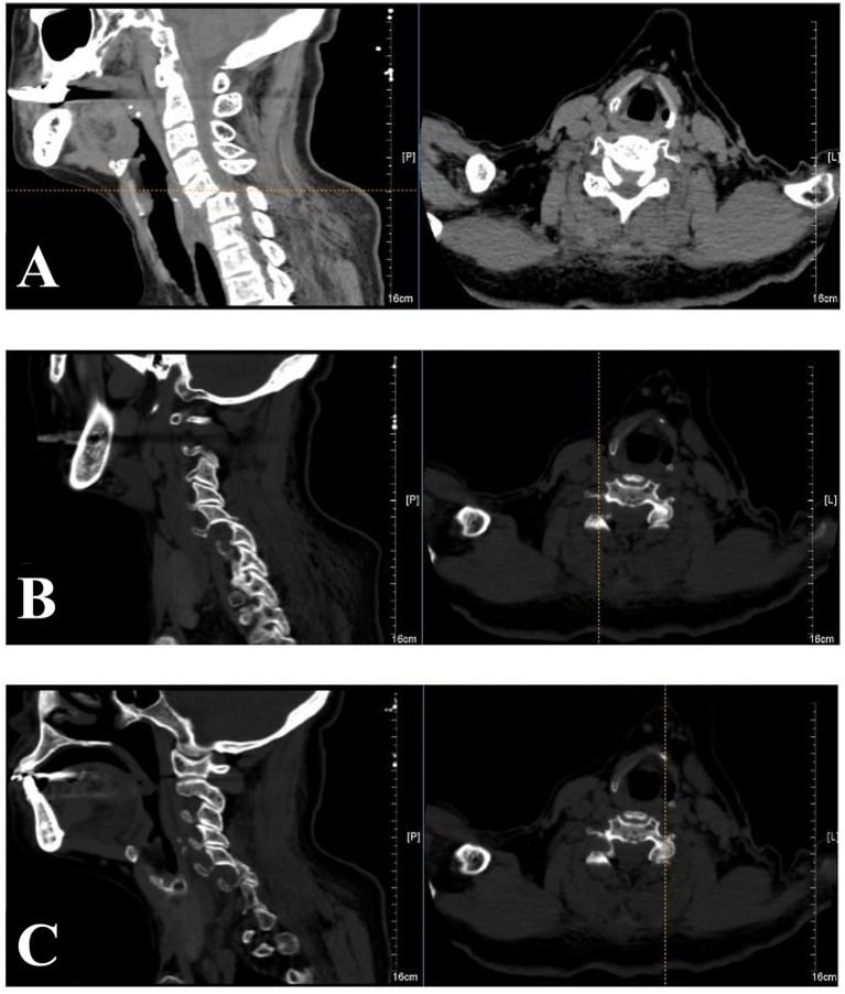 Midsagittal and parasagittal CT images showing bilateral C5-C6 facet dislocation with anterior translation of C5.