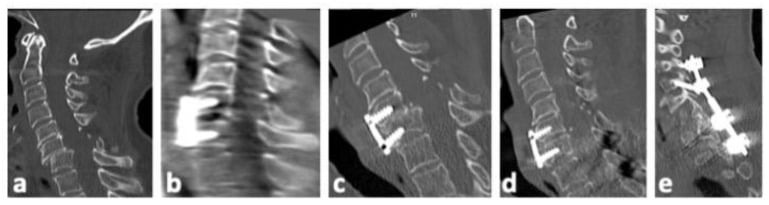 Serial CT showing C6-C7 facet-dislocation reduction and anterior fixation, early secondary displacement, then posterior reduction and stabilisation.