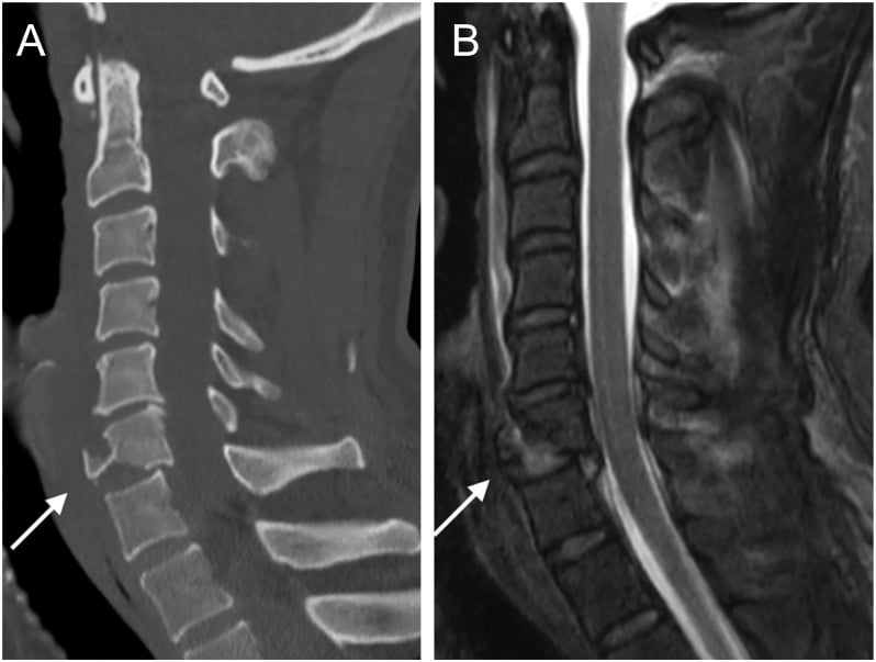 Sagittal CT and MRI of a C6 flexion teardrop fracture showing an anteroinferior fragment, retrolisthesis, disc disruption and cord signal change.
