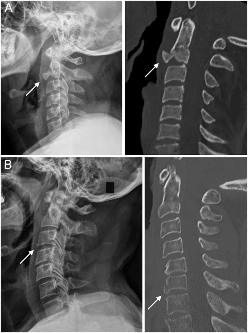 Radiograph and CT comparison of C2 and subaxial extension teardrop fractures showing small anteroinferior avulsion fragments.