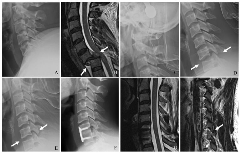 Radiograph and MRI of bilateral C6-C7 facet dislocation with traumatic disc herniation, followed by traction reduction and anterior discectomy and fusion.