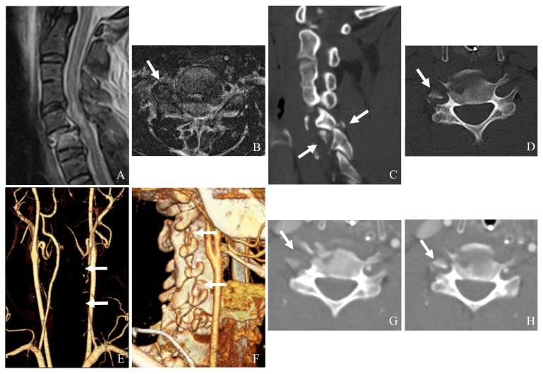 MRI, CT and CT angiography showing C5-C6 bilateral facet dislocation, a transforaminal fracture fragment and associated vertebral artery injury.