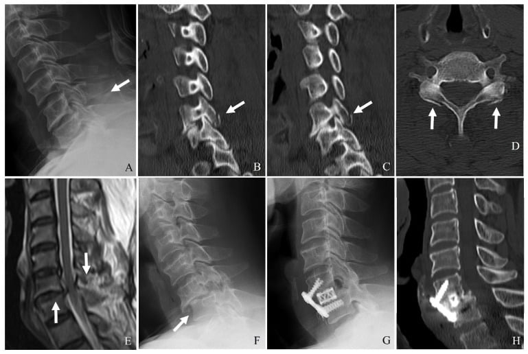 Serial radiograph, CT and MRI showing subtle C6-C7 facet and posterior ligament injuries followed by delayed bilateral facet dislocation in a rigid brace.