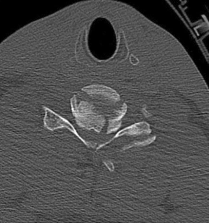 Axial CT of a subaxial cervical burst fracture showing vertebral-body comminution and posterior-wall involvement.