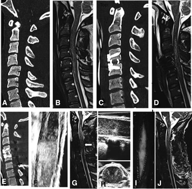 Sagittal CT and MRI of a C4-C5 unilateral locked-facet translation-rotation injury before and after traction reduction.