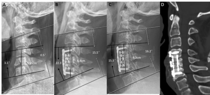 Serial radiographs and three-dimensional CT showing C5 burst fracture treated by corpectomy, titanium mesh cage and anterior plate with later fusion.