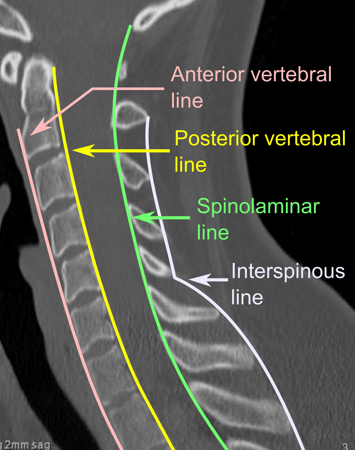 Sagittal cervical CT with the anterior vertebral, posterior vertebral, spinolaminar and interspinous alignment lines drawn.