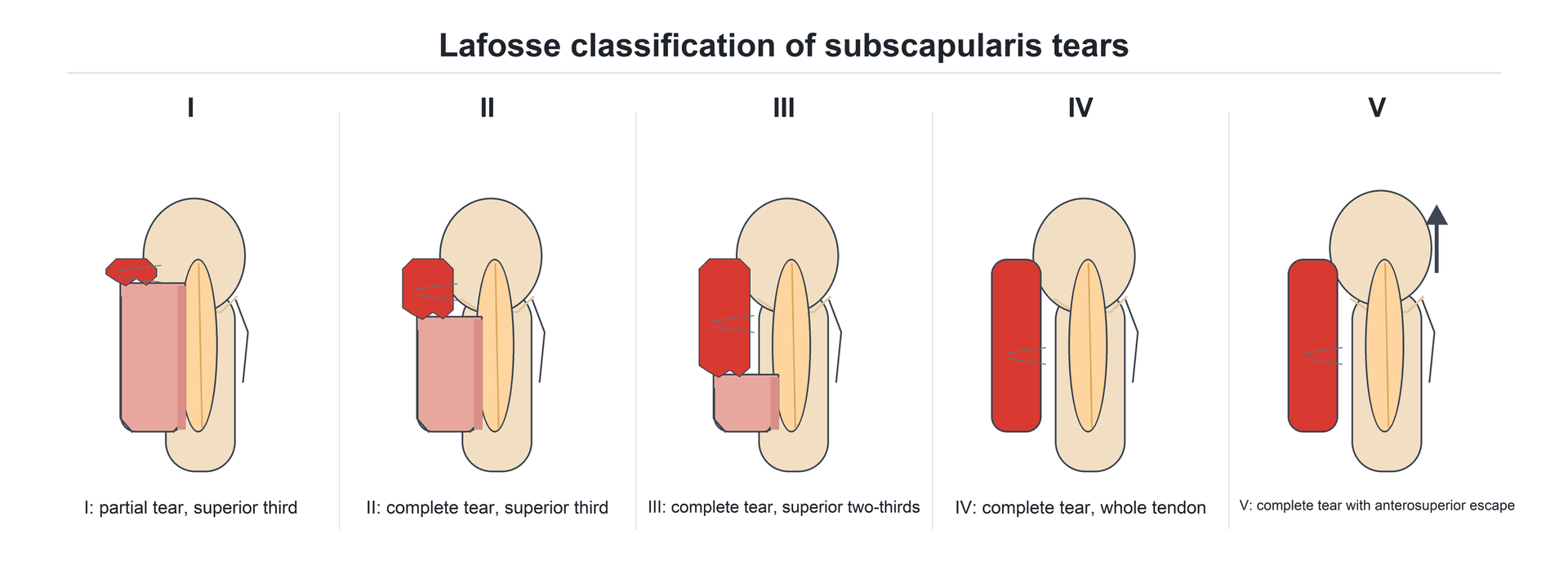 Five-panel schematic of the Lafosse classification of subscapularis tears, from a partial superior-third tear (I) to a complete tear with anterosuperior escape (V)