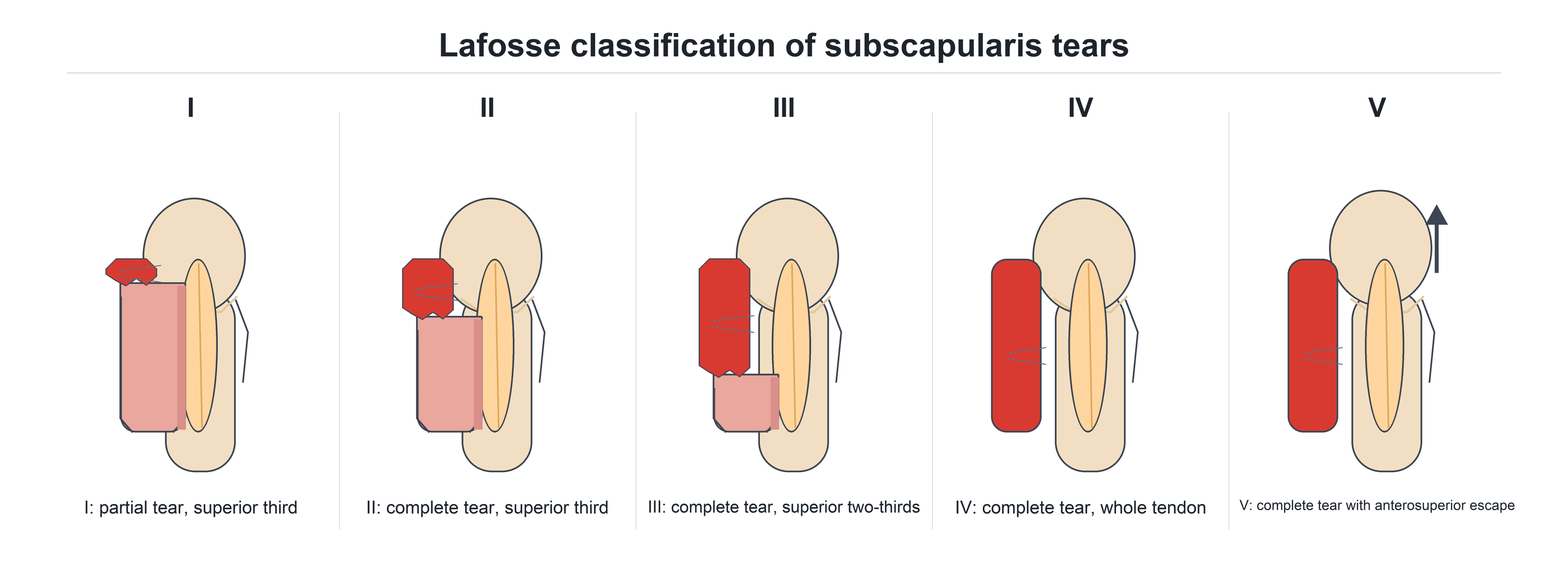 Five-panel schematic of the Lafosse classification of subscapularis tears, from a partial superior-third tear (I) to a complete tear with anterosuperior escape (V)