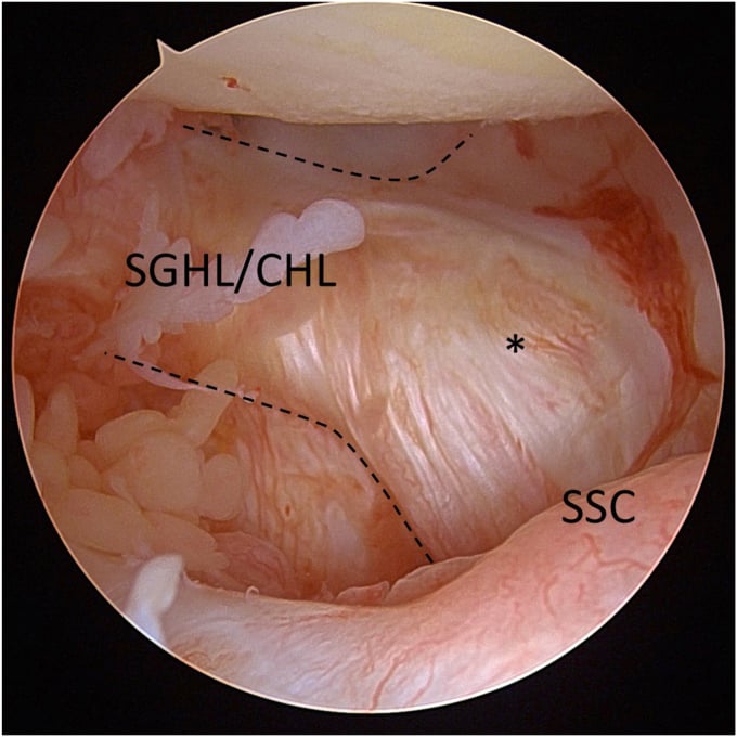 Posterior-portal arthroscopic view of a right shoulder labelling the arc-shaped superior glenohumeral and coracohumeral ligament complex attached to the torn subscapularis.