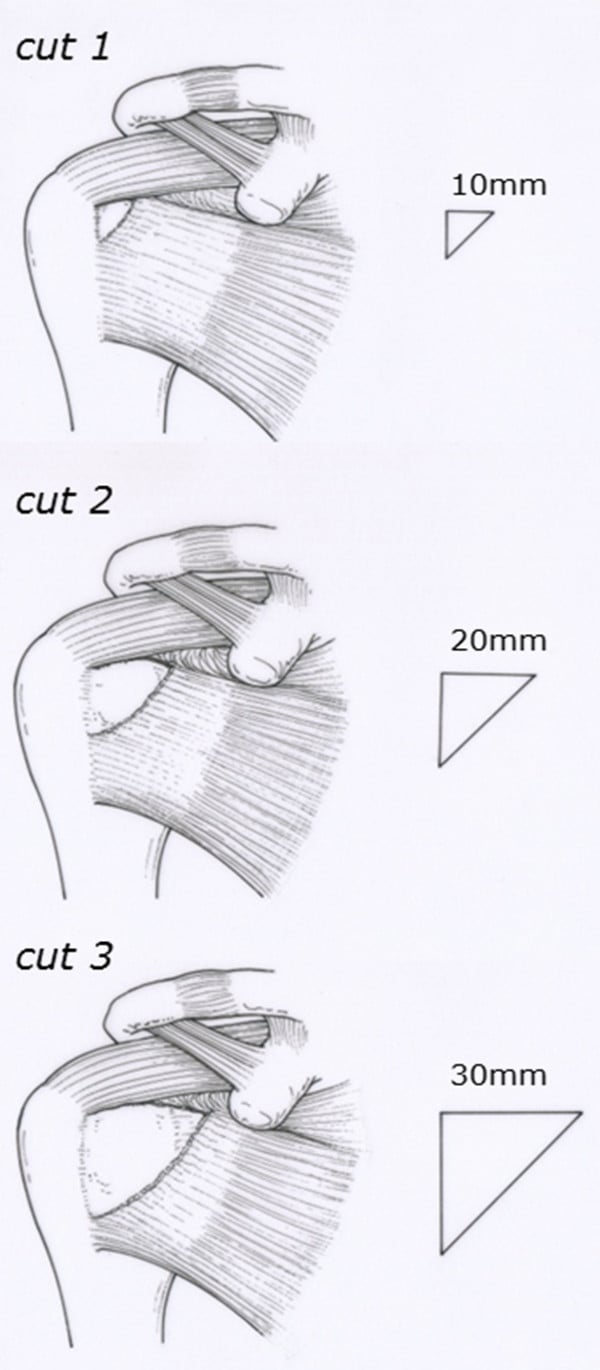 Three drawings of progressively larger triangular full-thickness defects in the superolateral subscapularis insertion, measuring 10, 20 and 30 millimetres.