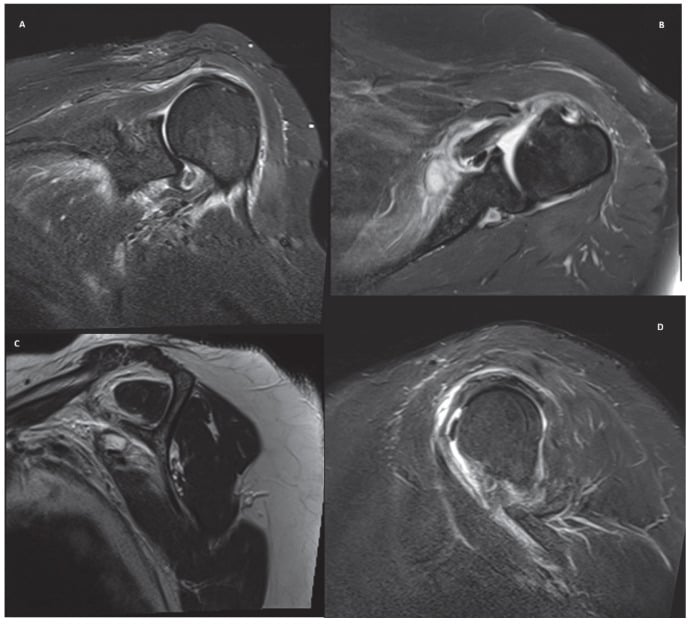 Four-panel shoulder MRI series in coronal, axial and sagittal planes showing an isolated Lafosse type II subscapularis tear.