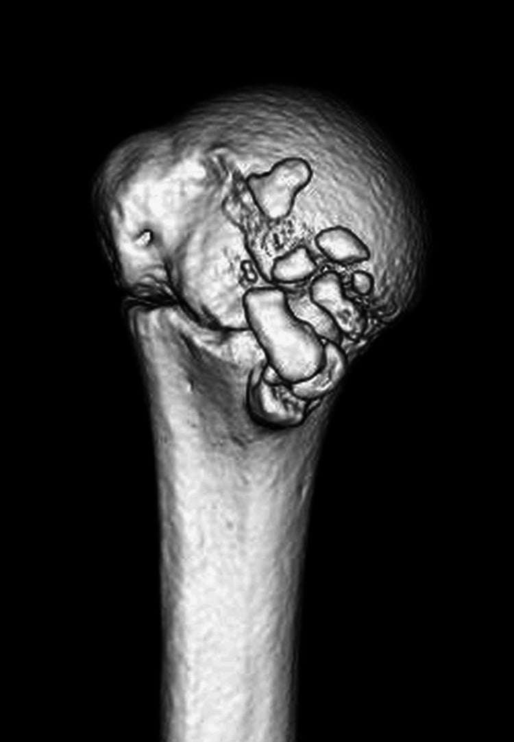Three-dimensional CT reconstruction showing multiple displaced fragments from the lesser tuberosity of the proximal humerus.