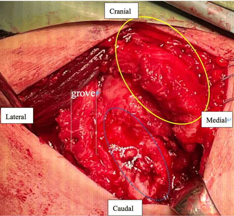 Open operative photograph showing the subscapularis and attached lesser-tuberosity fragments avulsed from the humeral footprint.