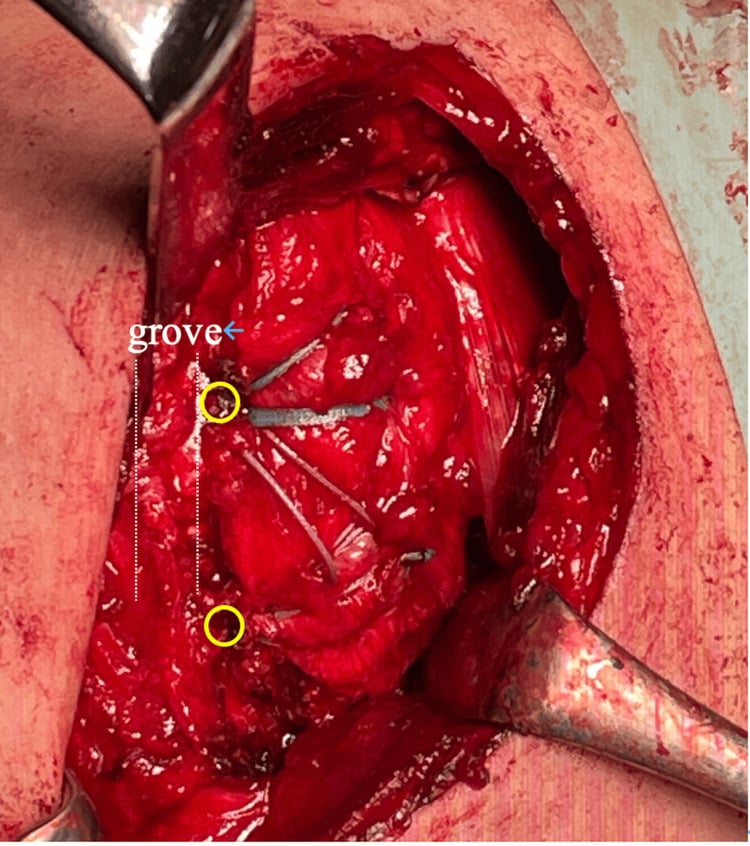 Open operative photograph after lesser-tuberosity fragment reduction and suture-bridge fixation with medial and lateral anchors.