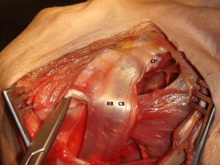 Deltopectoral cadaver dissection showing the pectoralis minor tendon detached from the coracoid and passed beneath the conjoint tendon toward the lesser tuberosity.