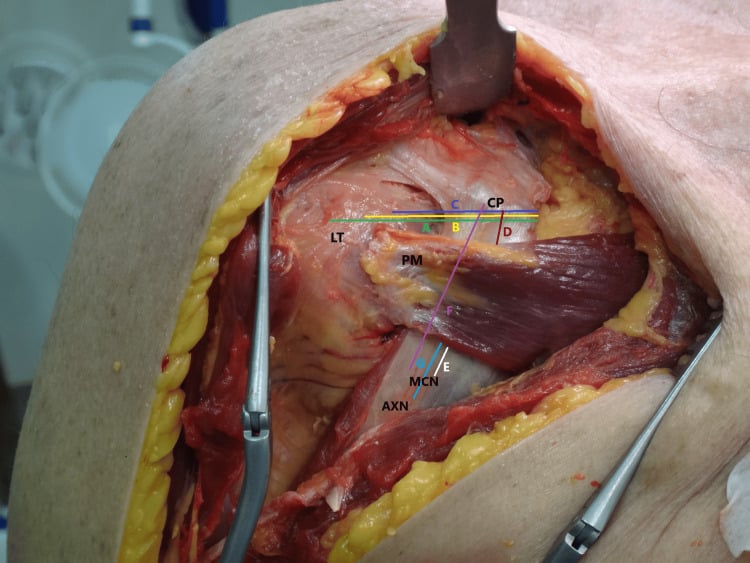 Cadaveric shoulder dissection with labelled distances from coracoid and transferred pectoralis minor to the musculocutaneous and axillary nerves.