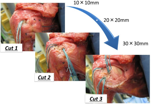 Cadaveric open shoulder photographs showing metallic suture anchors placed in the lesser tuberosity for repair of graded subscapularis defects.