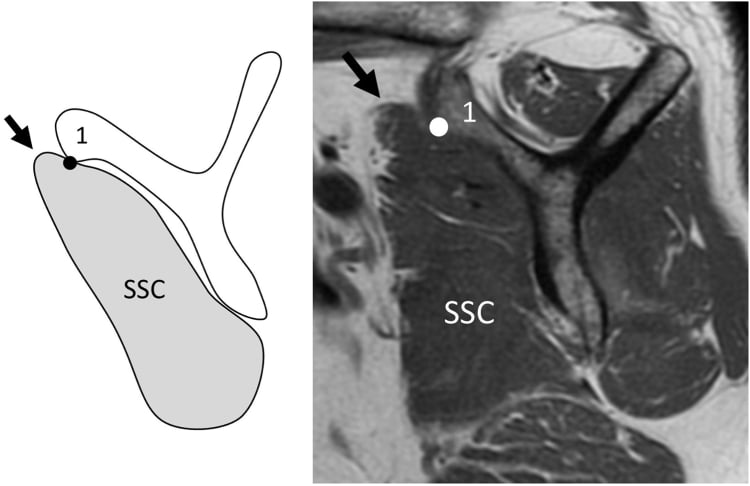 Oblique sagittal T1 MRI and companion diagram showing a normal subscapularis muscle contour cranial to the anteroinferior coracoid-base reference point.