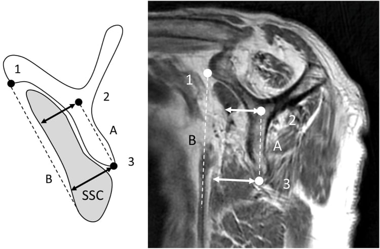 Oblique sagittal T1 MRI and reference-line diagram showing diffuse severe subscapularis atrophy.