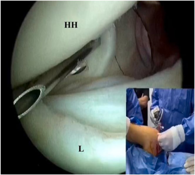 Posterior-portal arthroscopic view showing an outside-in needle passed through the subscapularis to establish a five-o-clock working portal.