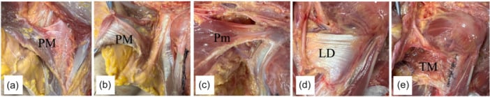 Five cadaveric panels showing the humeral insertions of pectoralis major, pectoralis minor, latissimus dorsi and teres major.