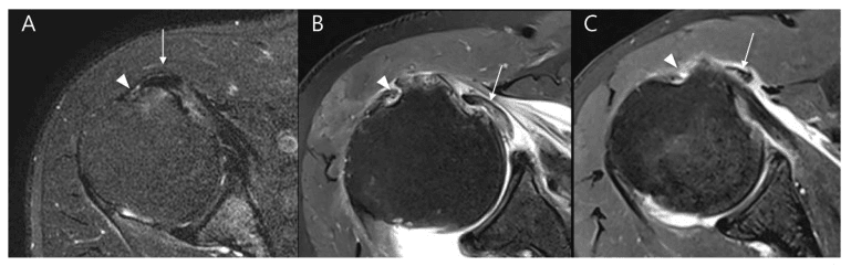 Three axial shoulder MRI panels (A-C), each marked with an arrowhead and an arrow, showing long head biceps subluxation and medial dislocation relative to the groove