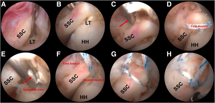 Eight-panel arthroscopic sequence (A-H) of a transtendon double-pulley subscapularis repair with all-suture anchors, labelled SSC, LT, HH, first anchor and second anchor