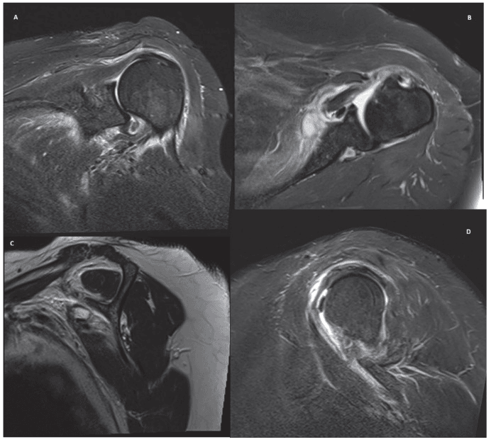 Four-panel shoulder MRI (A-D) in coronal, axial and sagittal planes showing an isolated Lafosse type 2 subscapularis tear