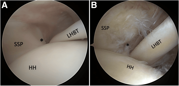 Arthroscopic comparison of the lateral biceps pulley beside supraspinatus: A intact, B disrupted, with SSP, LHBT and HH labelled
