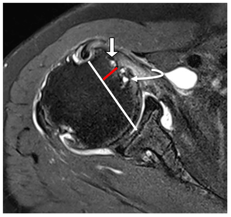 Axial fat-suppressed shoulder MRI showing a cyst within the lesser tuberosity at the subscapularis footprint, with a straight arrow, a curved arrow and white and red lines
